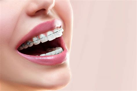 metal bracket behind teeth|best dental braces for adults.